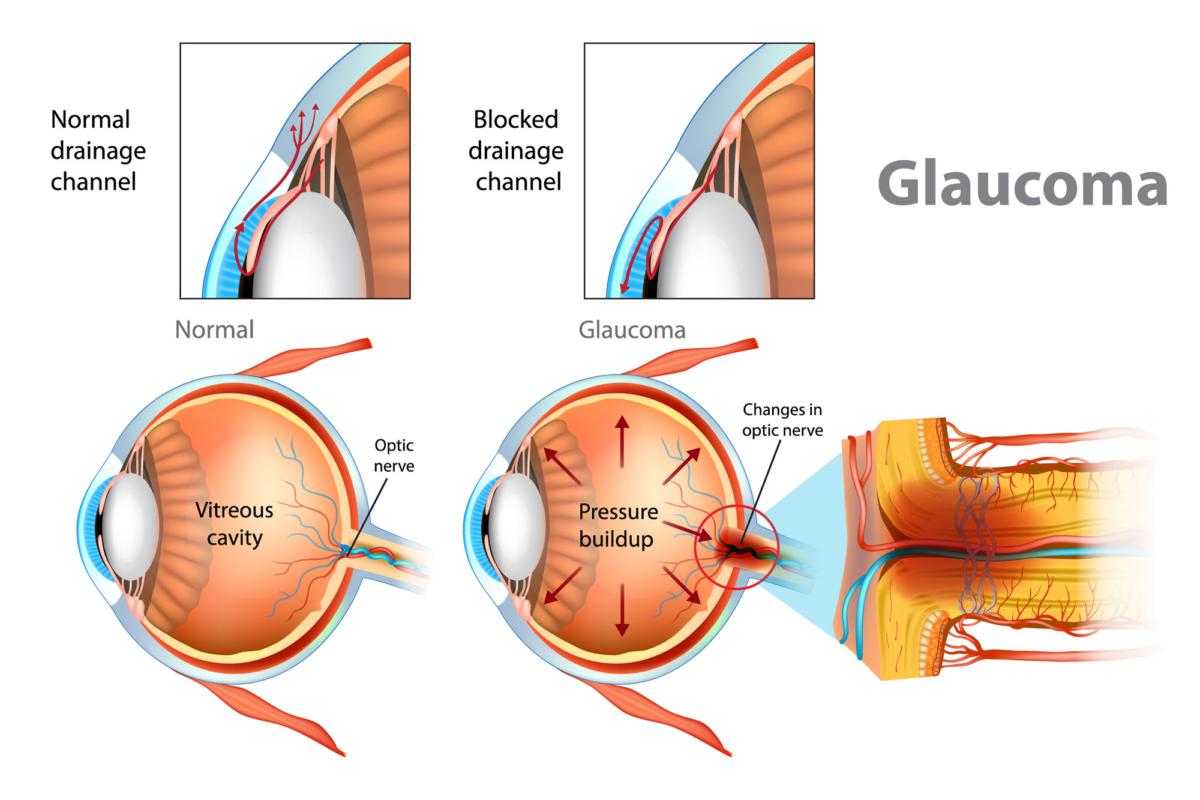 Glaucoma: Understanding the "Silent Thief of Sight"