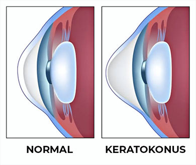 კერატოკონუსი - რა უნდა ვიცოდეთ დაავადების შესახებ?