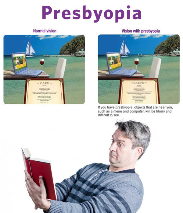 რა არის პრესბიოპია?